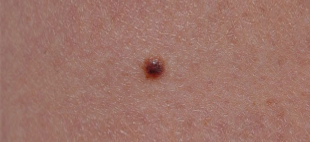 muttermalkontrolle-wien-melanomfrueherkennung