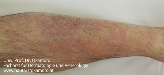 Ekzem nach einer Woche lokaler Behandlung bei Hautarzt Prof. Dr. Okamoto in Wien