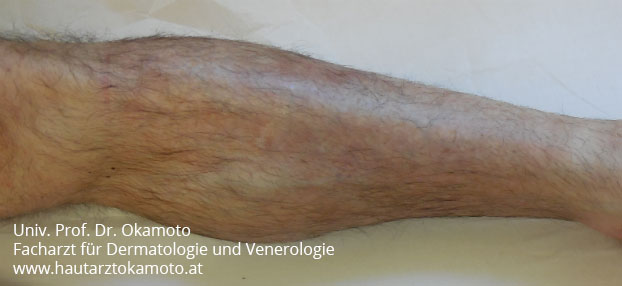 Ekzem nach 2 Woche lokaler Behandlung bei Hautarzt Prof. Dr. Okamoto in Wien