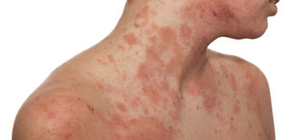 Atopische Dermatitis – Neurodermitis: Behandlung bei Hautarzt in Wien: Dr. Okamoto Atopische Dermatitis - Neurodermitis: Behandlung bei Hautarzt in Wien: Dr. Okamoto