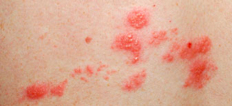Haut mit Herpes Zoster Haut mit Herpes Zoster