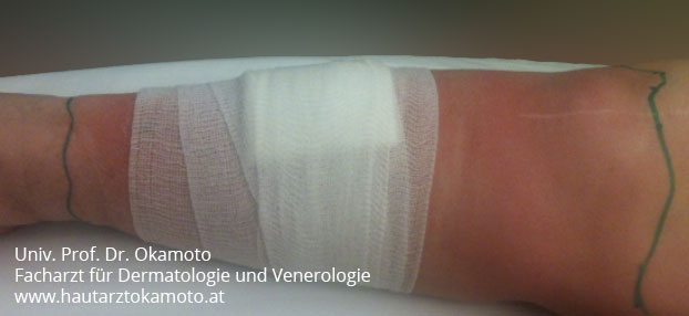 Rotlauf Behandlung in Wien bei Hautarzt Prof. Dr. Okamoto