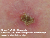 Squameous cell carcinoma (SCC) of the skin