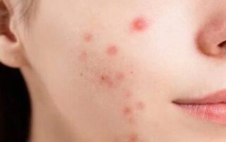 Face of woman with acne