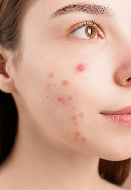 Face of woman with acne