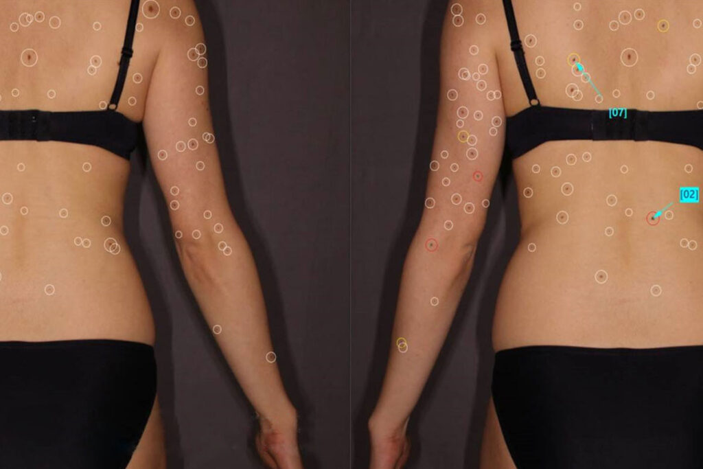 Mole check with total body mapping: photographs of the back with marked and numbered moles for follow-up monitoring